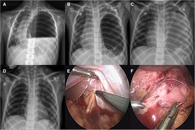 Case report: Emergency treatment of late-presenting congenital diaphragmatic hernia with tension gastrothorax in three Chinese children